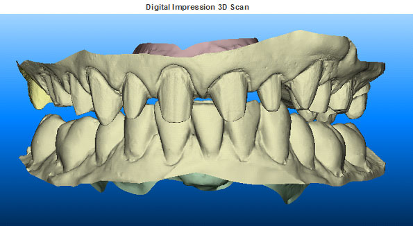Digital Impressions - 3D scan