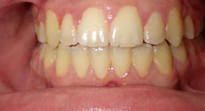 Before & After Orthodontic Treatment