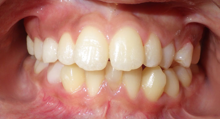 Before & After Orthodontic Treatment