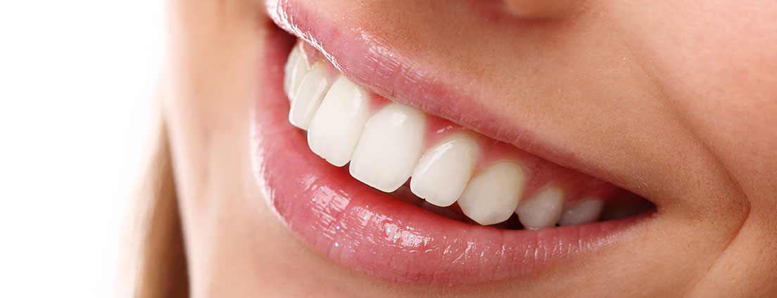Westgrove Dental - Porcelain Inlays