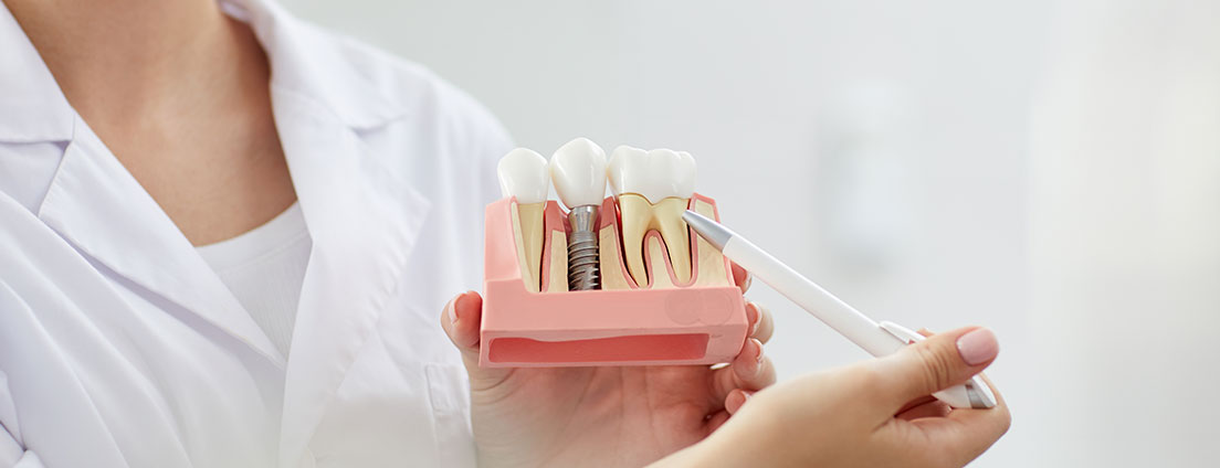 Westgrove Dental Center - Dental Implants