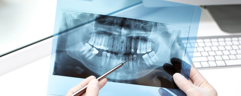 Panoramic X-ray - Westgrove Dental